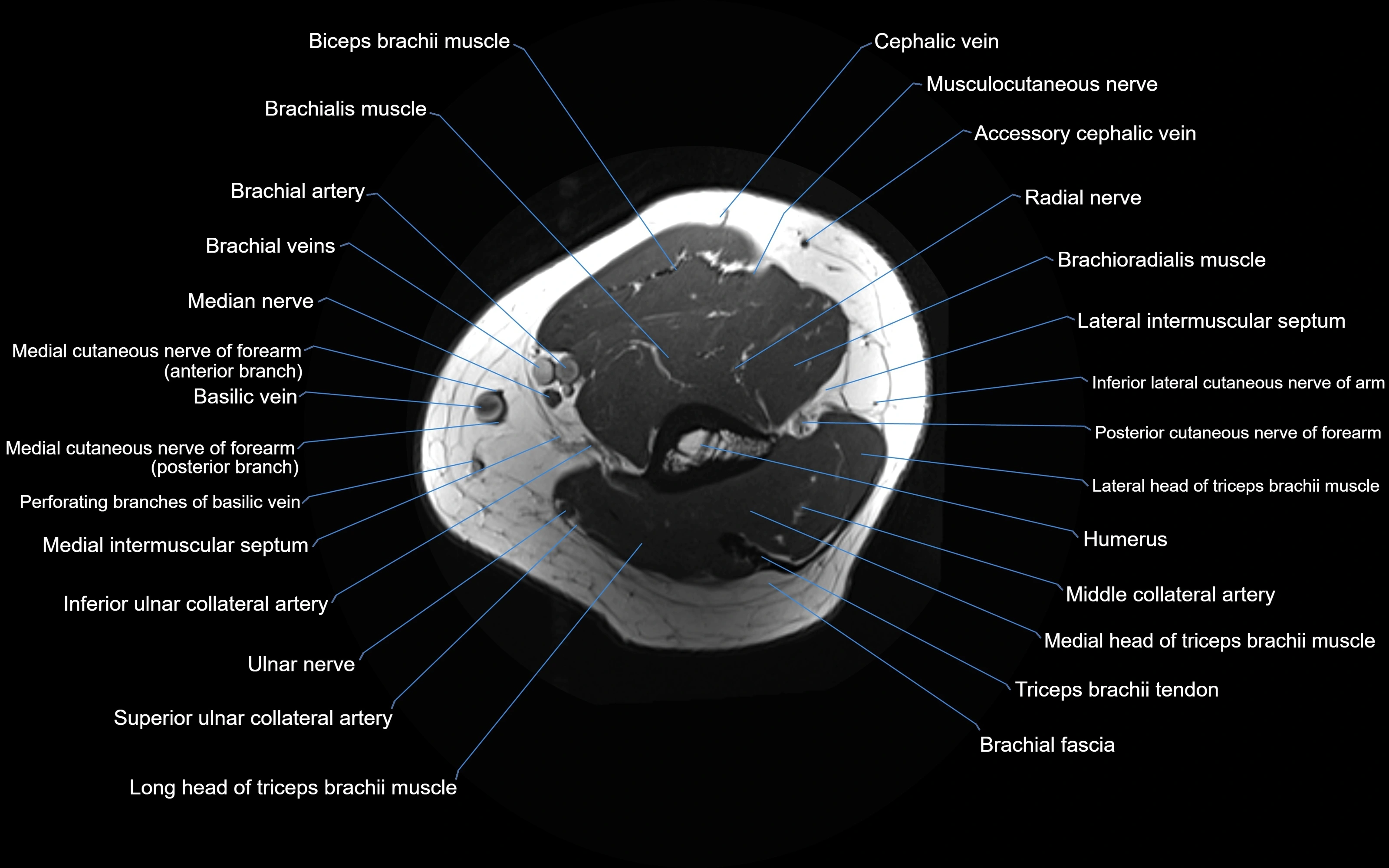 MRI elbow axial cross sectional anatomy 3T  radiology  image-img-00001-00002.webp
